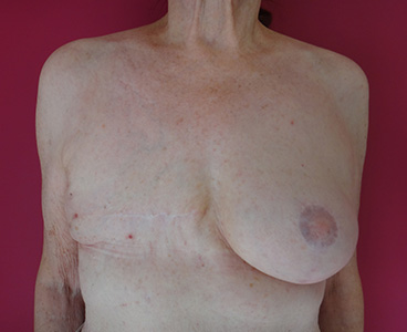 Reconstruction mammaire implant + lipofilling