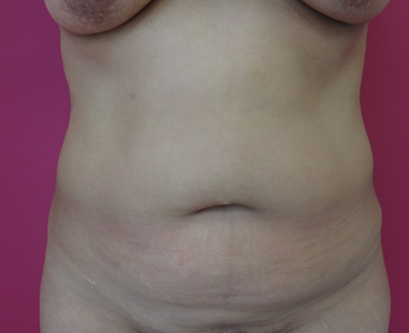 Abdominoplastie sous haute tension avec lipoaspiration et cure de diastasis