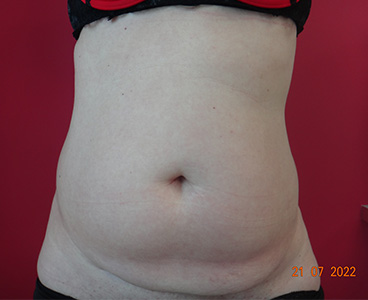 Lipoaspiration abdomen , hanches et mini lift inferieur