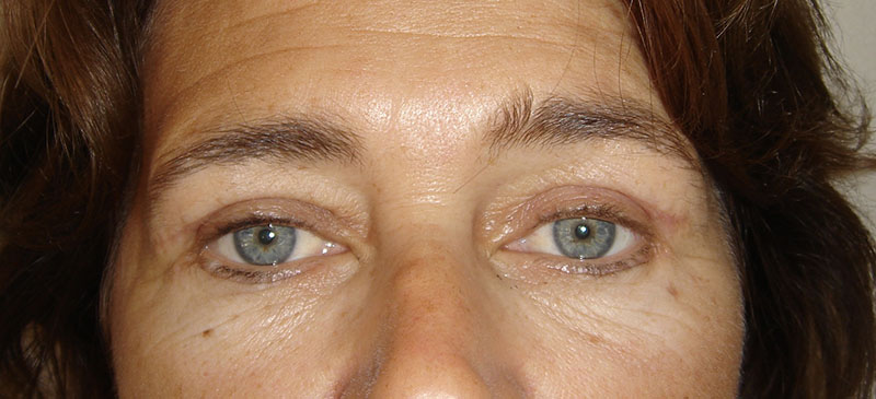 Blépharoplastie superieure et inferieure