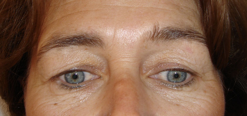 Blépharoplastie superieure et inferieure