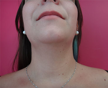 Lipoaspiration cervicale et du bas du visage