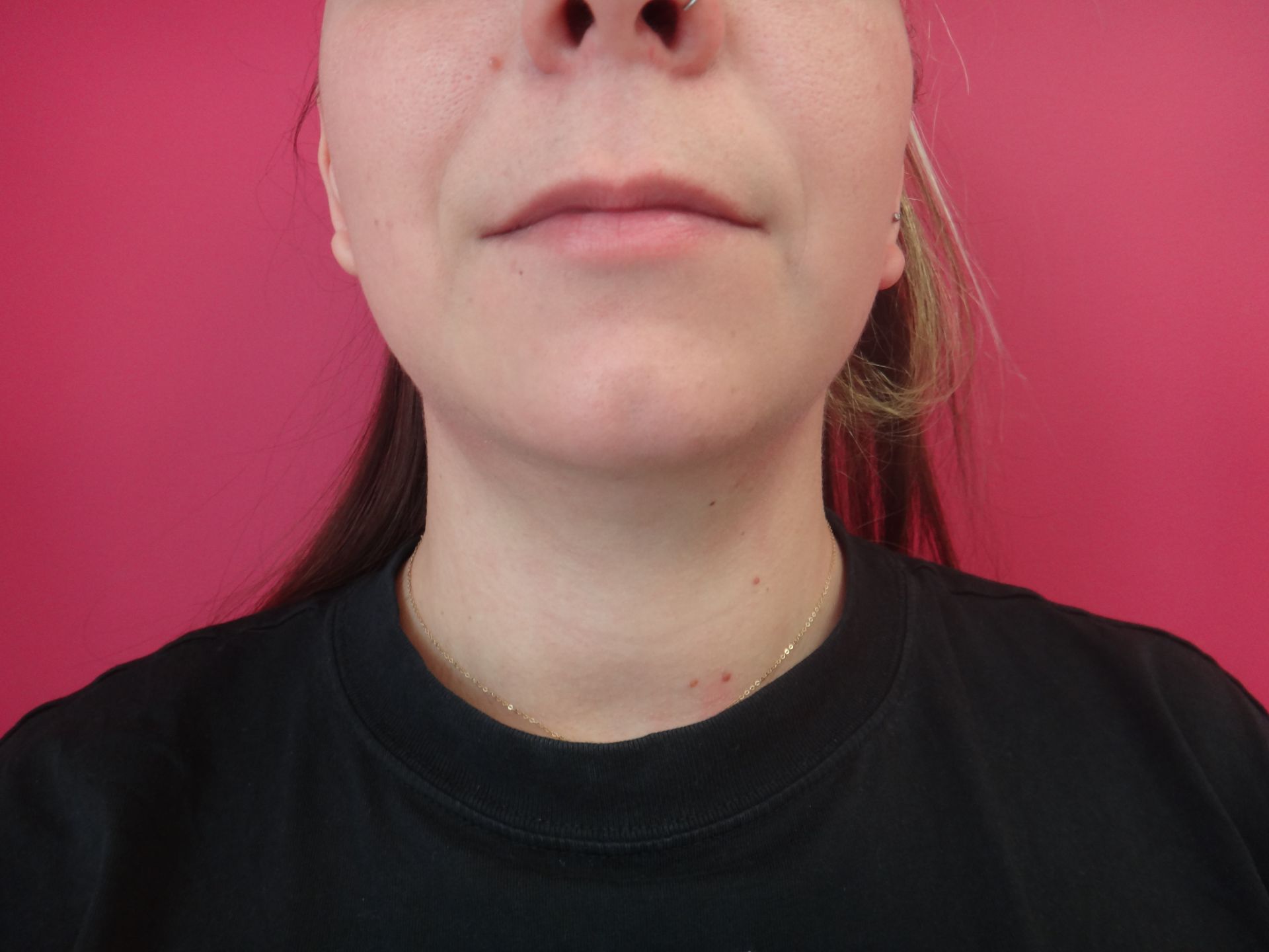 Lipoaspiration cervicale et du bas du visage