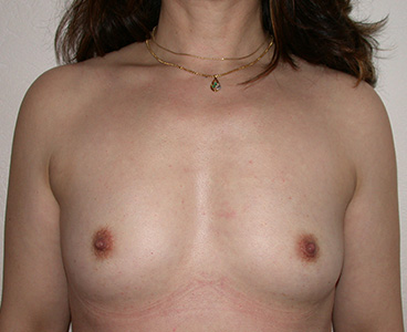 Implant rond en pre pectoral voie sous mammaire