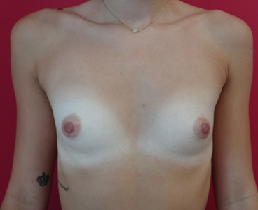 Asymetrie mammaire implant rond retro pectoral