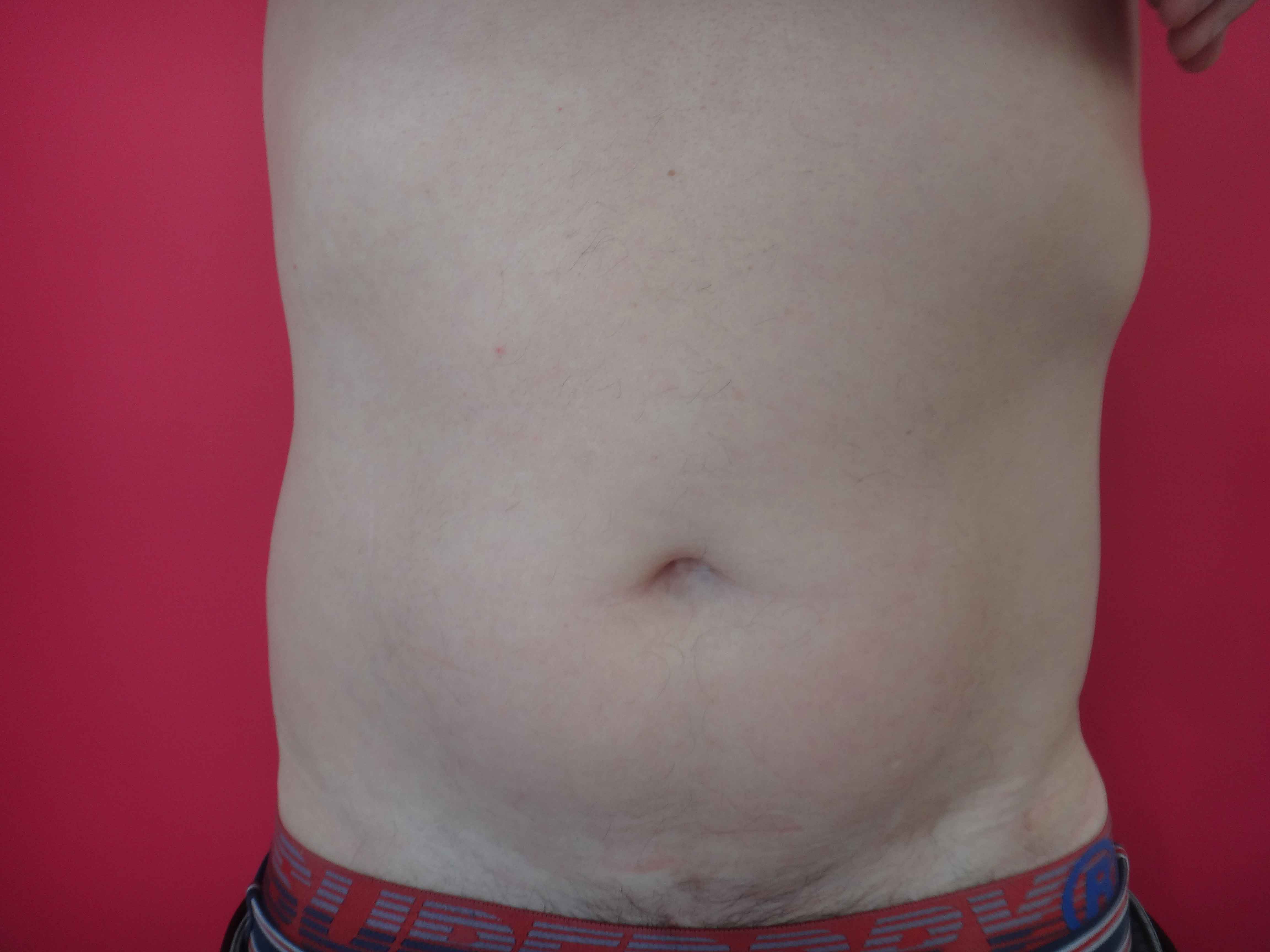 Lipoaspiration abdomen hanche