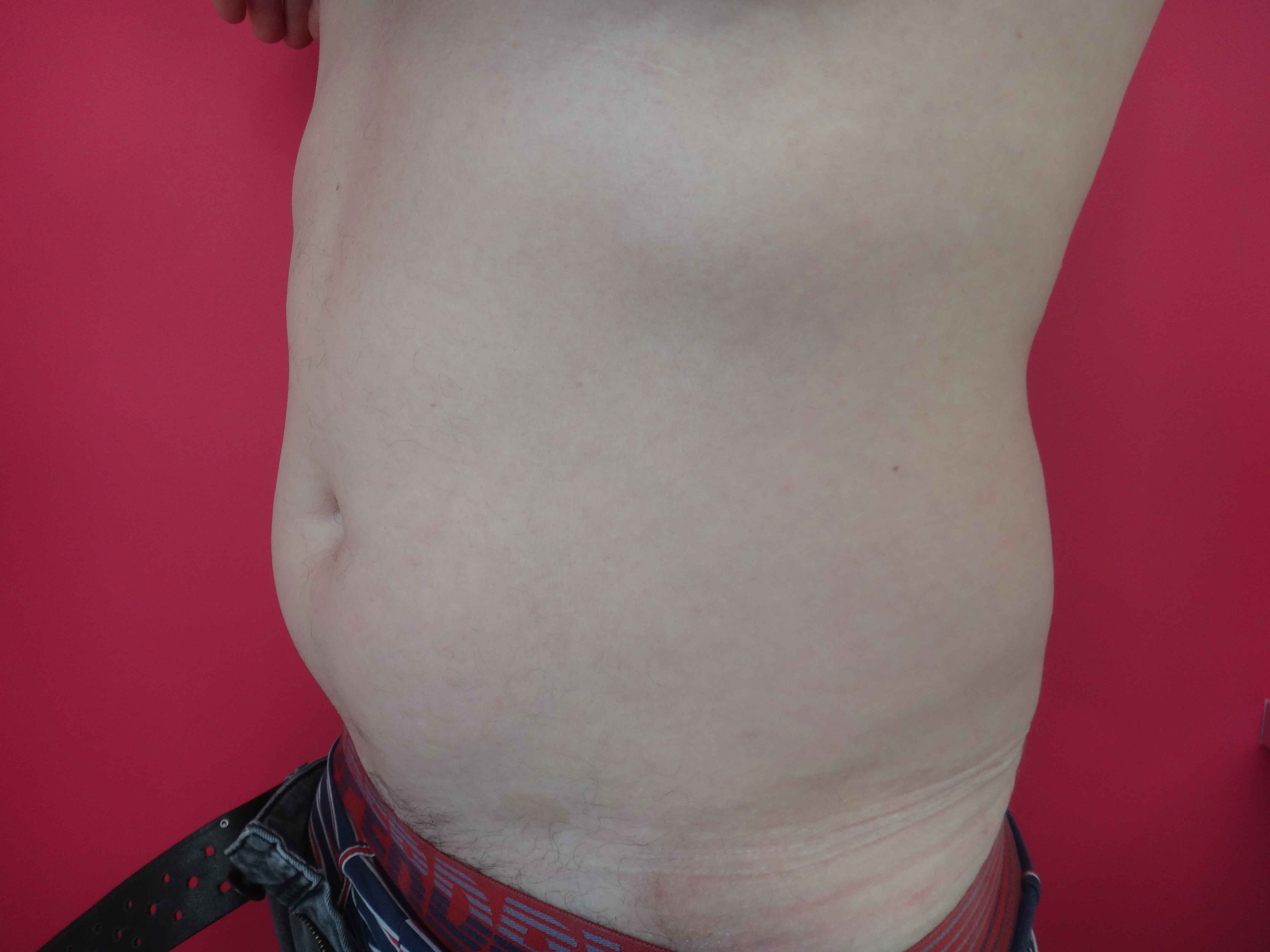 Lipoaspiration abdomen hanche