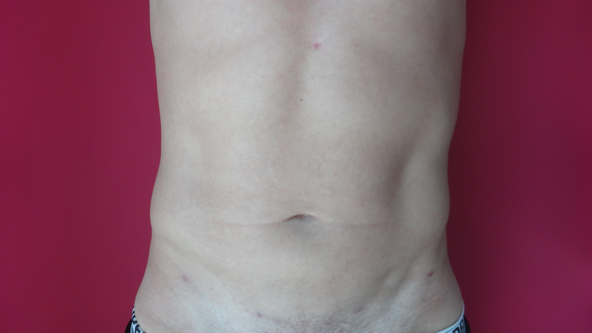 Lipoaspiration abdomen hanche