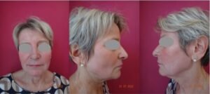 Peeling profond au Phénol / Après
