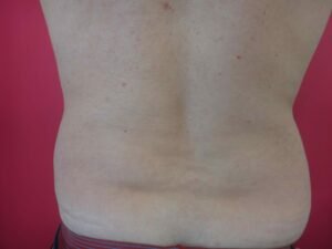 Lipoaspiration du dos à Aix / après