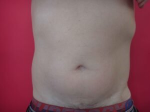 Lipoaspiration abdomen hanche Aix / avant