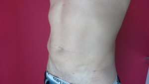 Lipoaspiration abdomen hanche / après