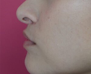 Augmentation modéré du volume des lèvres / avant