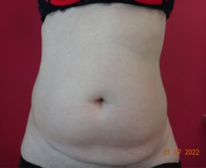 Liposuccion Ventr eà Aix / avant