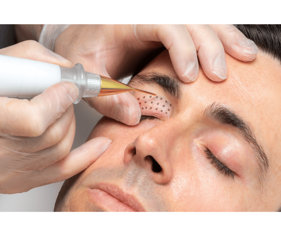 Blépharoplastie pour les hommes