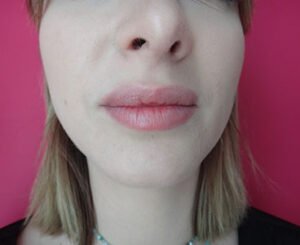 Augmentation du volume des lèvres Aix