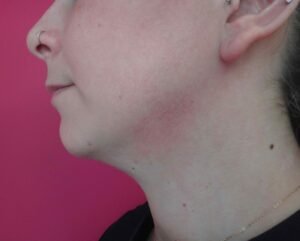 Lipoaspiration du cou / Après