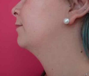 Lipoaspiration du cou / Avant