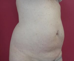 Lipoaspiration ventre à Aix / avant