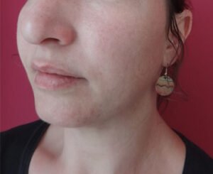 Lipoaspiration cervicale et de l'ovale face Après