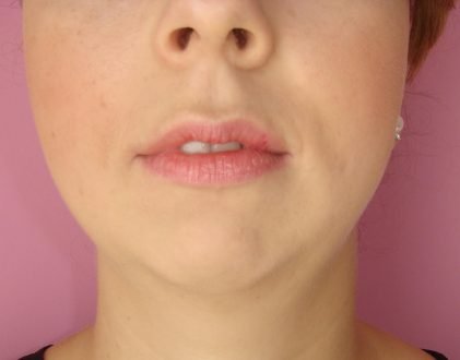 Génioplastie par lipofilling / avant face