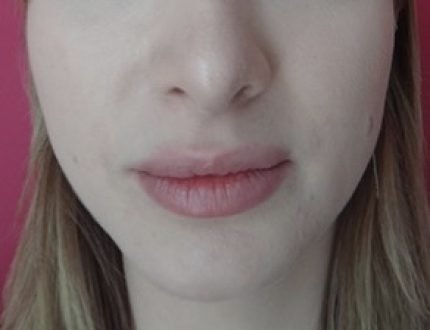 lipofillingvisage / après face