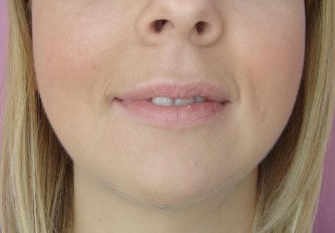 Génioplastie par lipofilling / après face