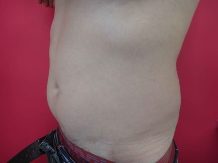 Lipoaspiration abdomen hanche / avant