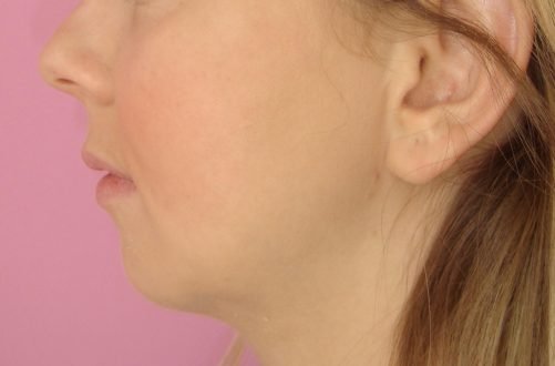 Génioplastie par lipofilling / après profil