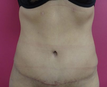 Abdominoplastie à Aix / Après