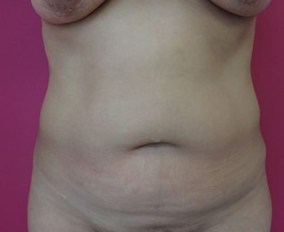 Abdominoplastie à Aix / Avant