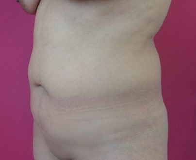 abdominoplastie-profil