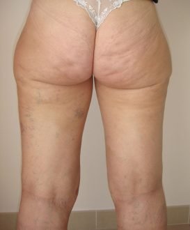 Liposuccion et lift de face interne de cuisses / après dos