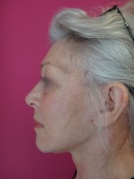 Lifting cervico facial / après profil