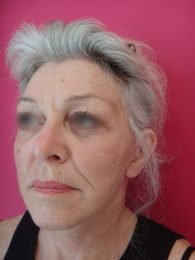 Lifting cervico facial / après coté