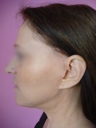 Lifting facial / après profil