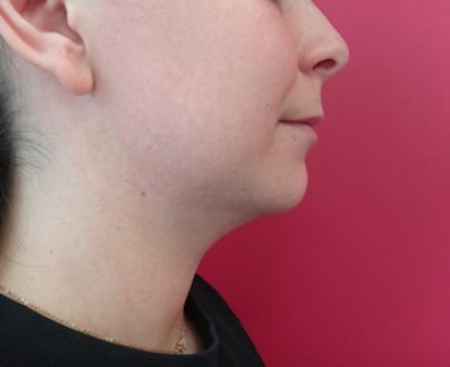 Lipoaspiration cervicale et du bas du visage / après profil