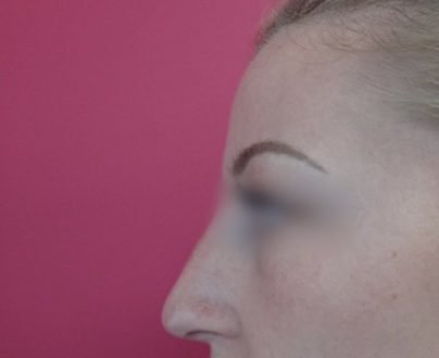 Rhinoplastie médicales / après profil