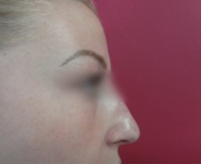 Rhinoplastie médicales / après profil