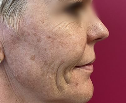 Peeling moyen anti-tâches - Avant profil