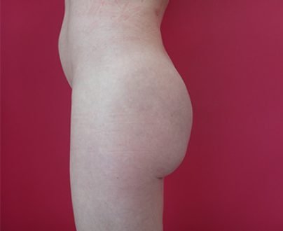 Augmentation des fesses par acide hyaluronique avant profil