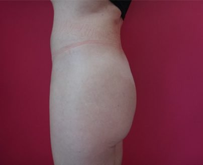 Augmentation des fesses par acide hyaluronique après profil