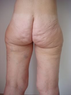 Liposuccion et lift de face interne de cuisses / avant dos