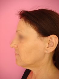 Lifting facial / avant profil