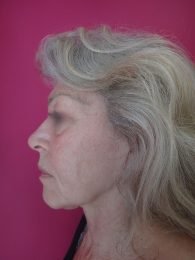 Lifting cervico facial / avant profil