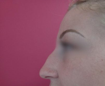 Rhinoplastie médicales / avant profil