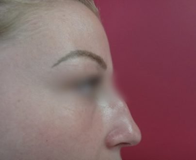 Rhinoplastie médicales / avant profil