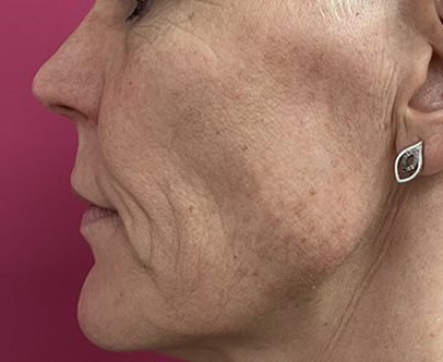 Peeling moyen anti-tâches - Après profil