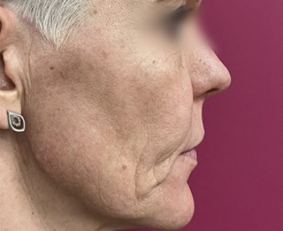 Peeling moyen anti-tâches - Après profil