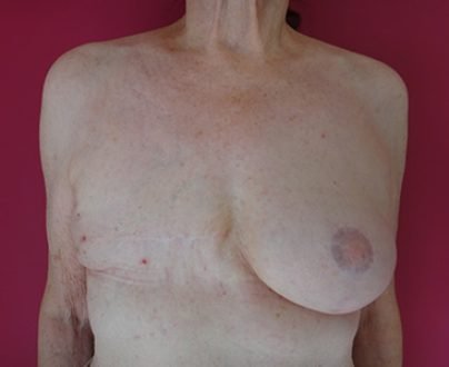 Reconstruction mammaire implant + lipofilling / après